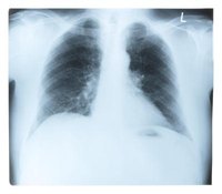 Symptoms of Bruised or Cracked Ribs