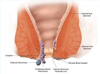 Get Rid of Hemorrhoids With Home Remedies