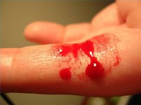 A bleeding finger.