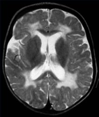 Chronic White Matter Disease