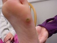 Plantar wart