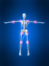 Arthritis