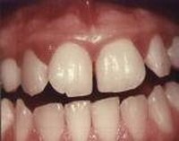 Causes of Sore Gums