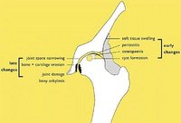 Degenerative Hip Bone Disease
