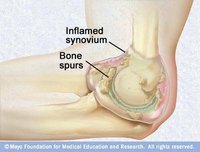 Treatment for Elbow Bone Spurs