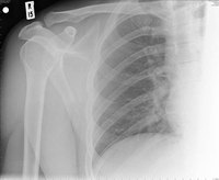 What Is a Bone Lesion?