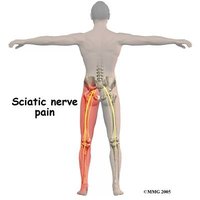 Treatment of Piriformis Syndrome