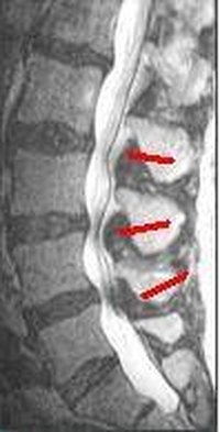 What Are the Crippling Symptoms of Spinal Stenosis?