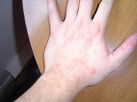 Treat Hives