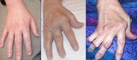 Signs of Arthritis in the Hands
