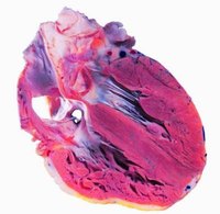 Causes and Symptoms of a Weak Heart