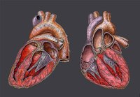 What is Mild Cardiomegaly?