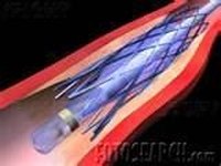What Is a Stent for a Blocked Artery?
