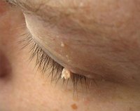 Filiform wart on eyelid