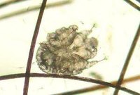 Cause of Scabies