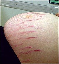 How to remove Stretch Marks. No need for stretch mark surgery to get rid of them. You can get cream revitol to take care of them.