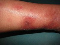 What Causes Erythematous?