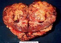 A kidney oncocytoma is a benign tumor of the kidney.
