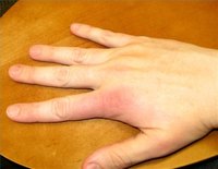 Hand Pain
