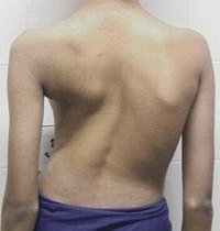 What Are the Causes of Sclerosis?