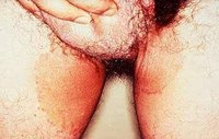 What Are the Causes of Jock Itch?