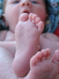 Staph Infection Causes in Babies