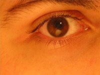 Signs & Symptoms of Cataracts