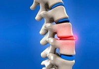 Signs & Symptoms of a Bulging Disk
