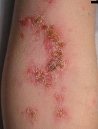 Infantigo Disease