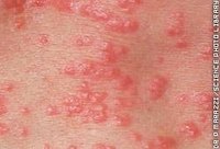 What Should Scabies Look Like?