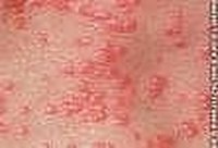 Scabies Rash