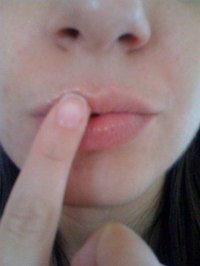 Get Rid of Cold Sore Scabs