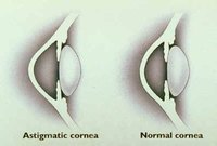 Astigmatism