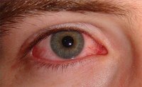 How Long Does It Take for Pinkeye to Clear Up?