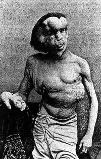 What Are the Symptoms of Elephant Man Disease?