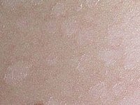 How To Recognize And Treat Tinea Versicolor