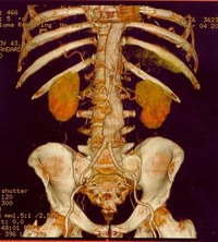 Symptoms of a Ruptured Abdominal Aortic Aneurysm