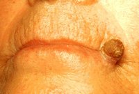 actinic keratosis