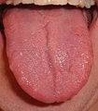 Medical Conditions That Affect the Tongue