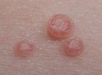 What Are Molluscum Warts?