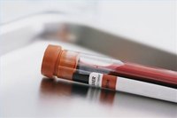 Reasons for Low White Blood Cells