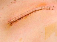 Healing the scar from a surgery will take a long time, but healing the muscle will take even longer.