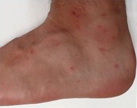 Chigger bites on an ankle