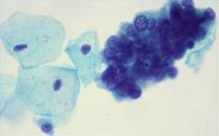 Stages of Adenocarcinoma