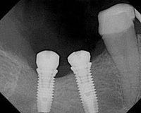 Signs of Dental Implant Infection