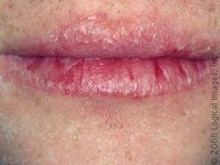 What Causes Cracked Split Lips?