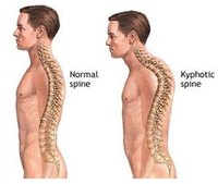 What Is Kyphoscoliosis?