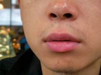 Chronic Sinusitis Symptoms: Balance & Vision Problems
