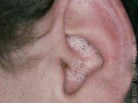 What Causes Blackheads in the Ears?