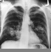 This is an x-ray image of a chest. The growth on the left side of the lung could be lung cancer.